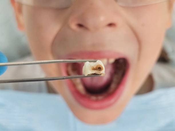 Teeth Whitening in MT